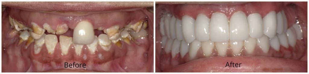 dental implants